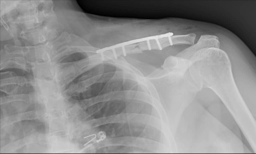 Plaque Clavicule