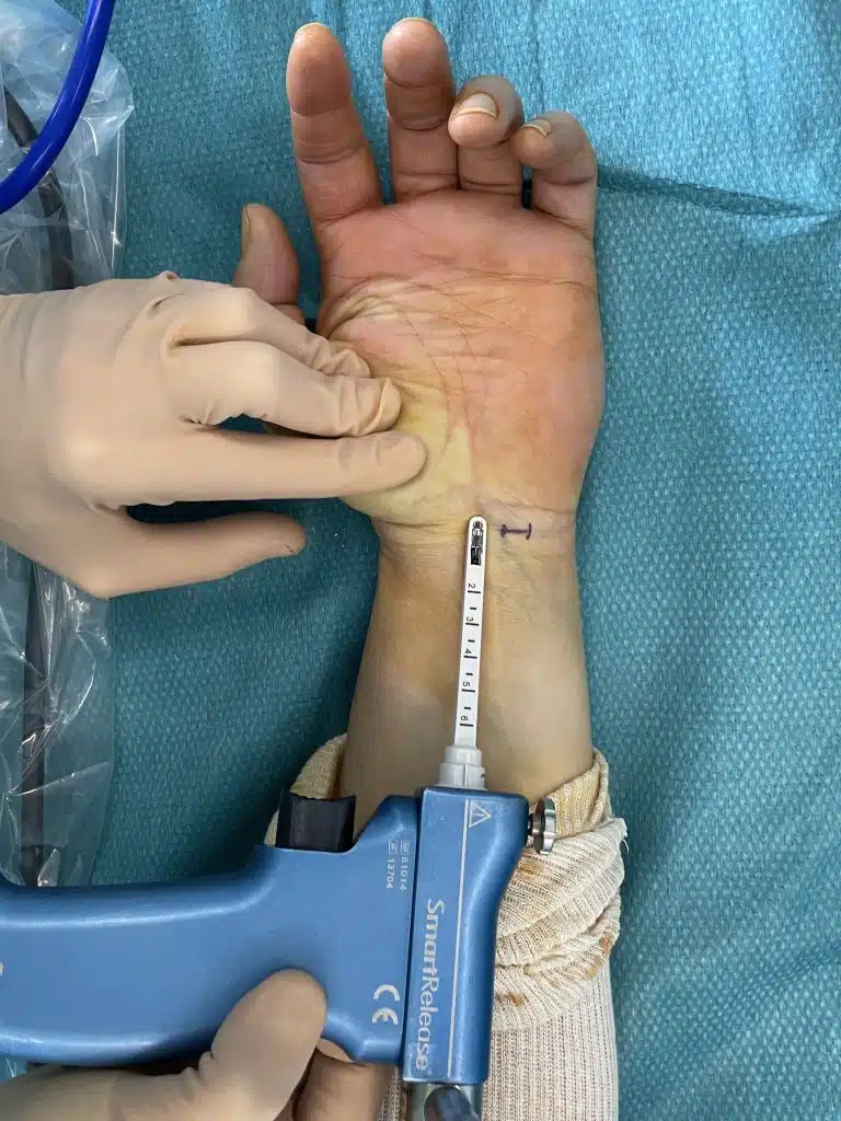 Libération du Canal Carpien par Endoscopie