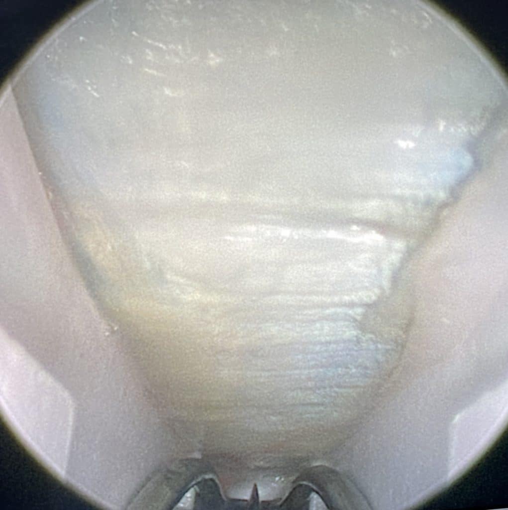 Ouverture du canal carpien par endoscopie