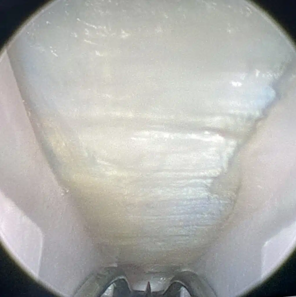 Ouverture du canal carpien par endoscopie
