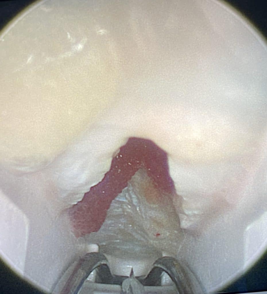 Ouverture du canal carpien par endoscopie