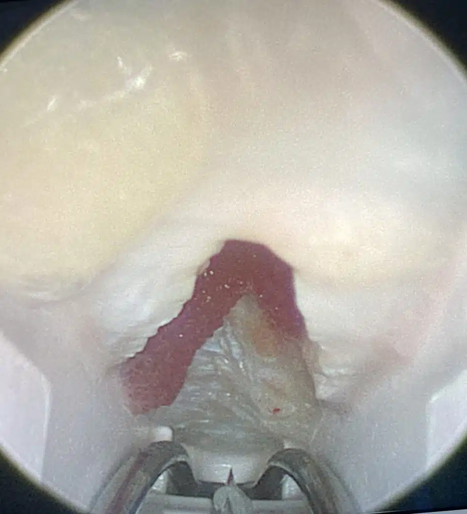 Ouverture du canal carpien par endoscopie