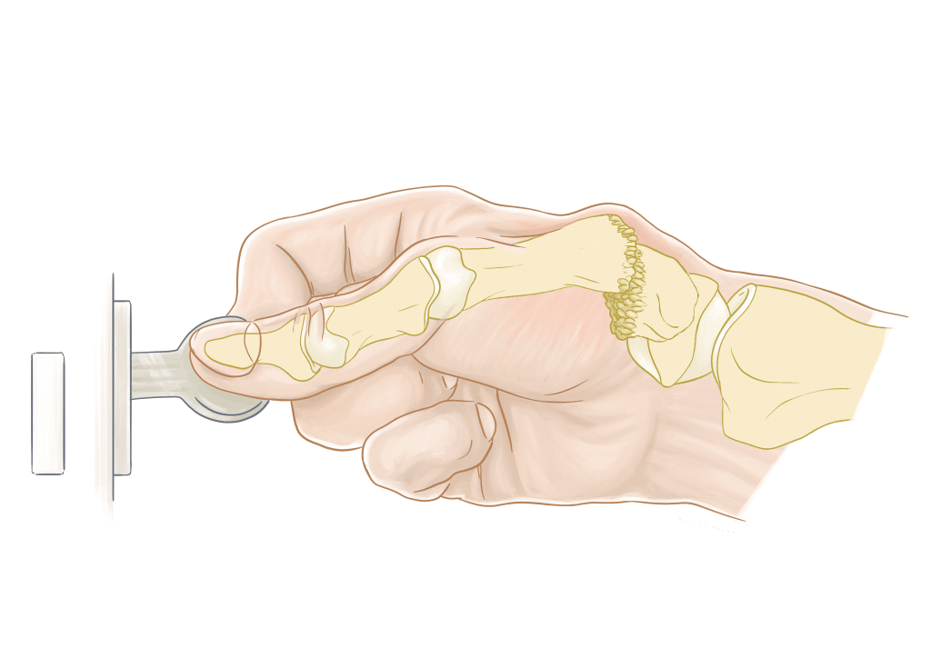 Rhizarthrose (Arthrose du pouce) — Dr Lior Amsallem