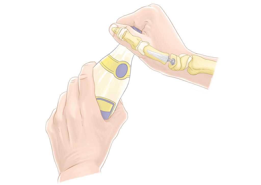 Prothèse Trapezo-Métacarpienne (Touch - Keri Médical)