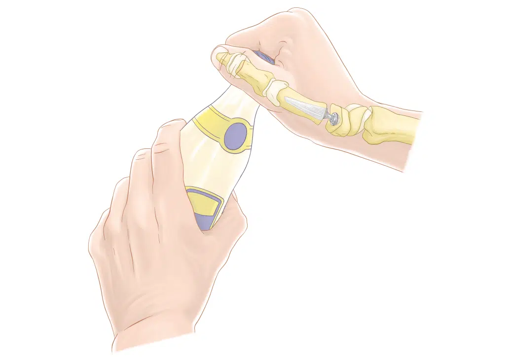 Prothèse Trapezo-Métacarpienne (Touch - Keri Médical)