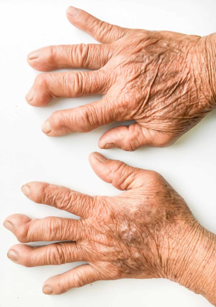 Arthrose des doigts, articulations déformées et douloureuses des mains