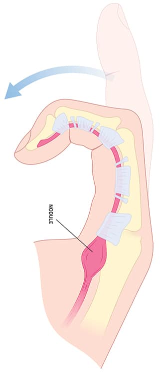 Coupe d'un doigt fléchi montrant le nodule du tendon fléchisseur bloqué sous sa poulie, qui empêche le doigt de se déplier