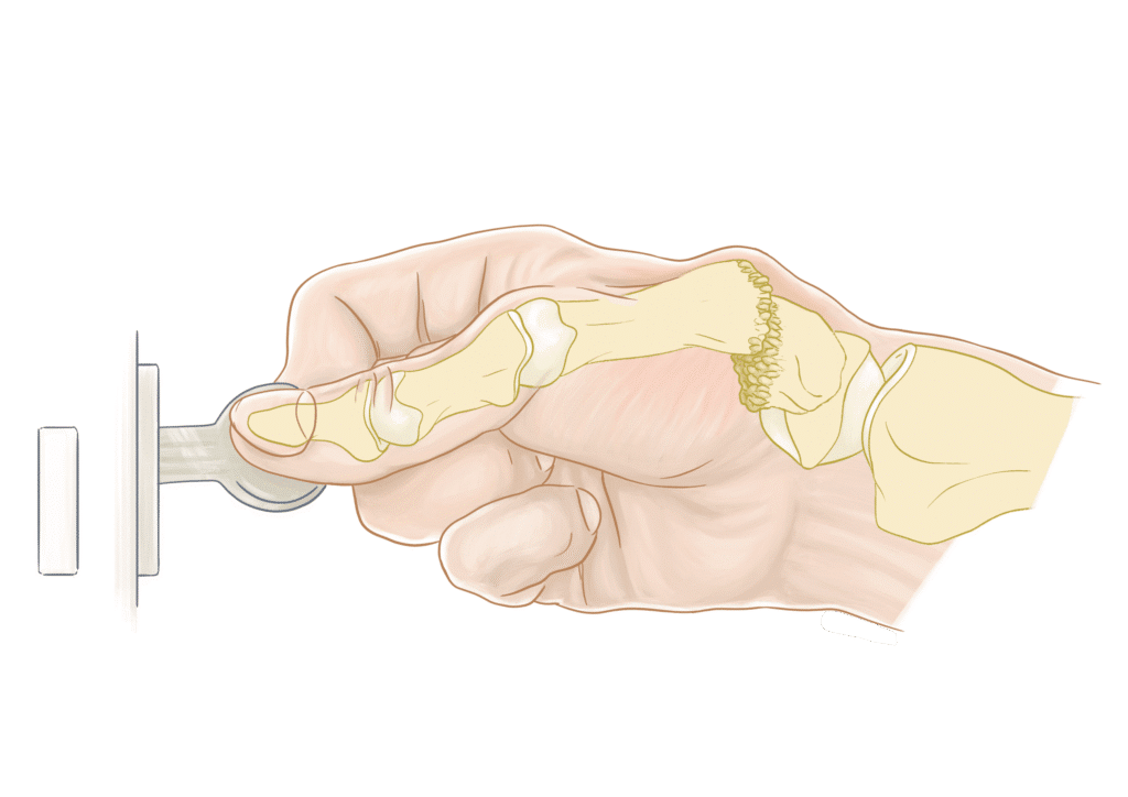 Main en train de tourner une clé, avec l'articulation usée à la base du pouce, le geste qui déclenche la douleur de la rhizarthrose
