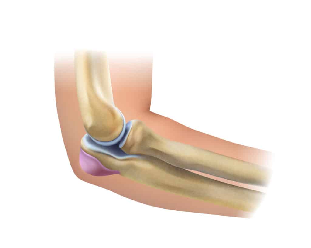 Hygroma du Coude — Dr Lior Amsallem