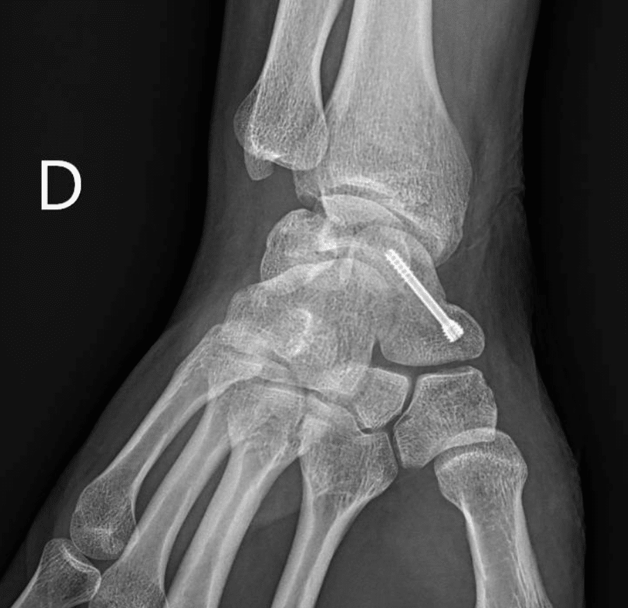 Vissage scaphoide