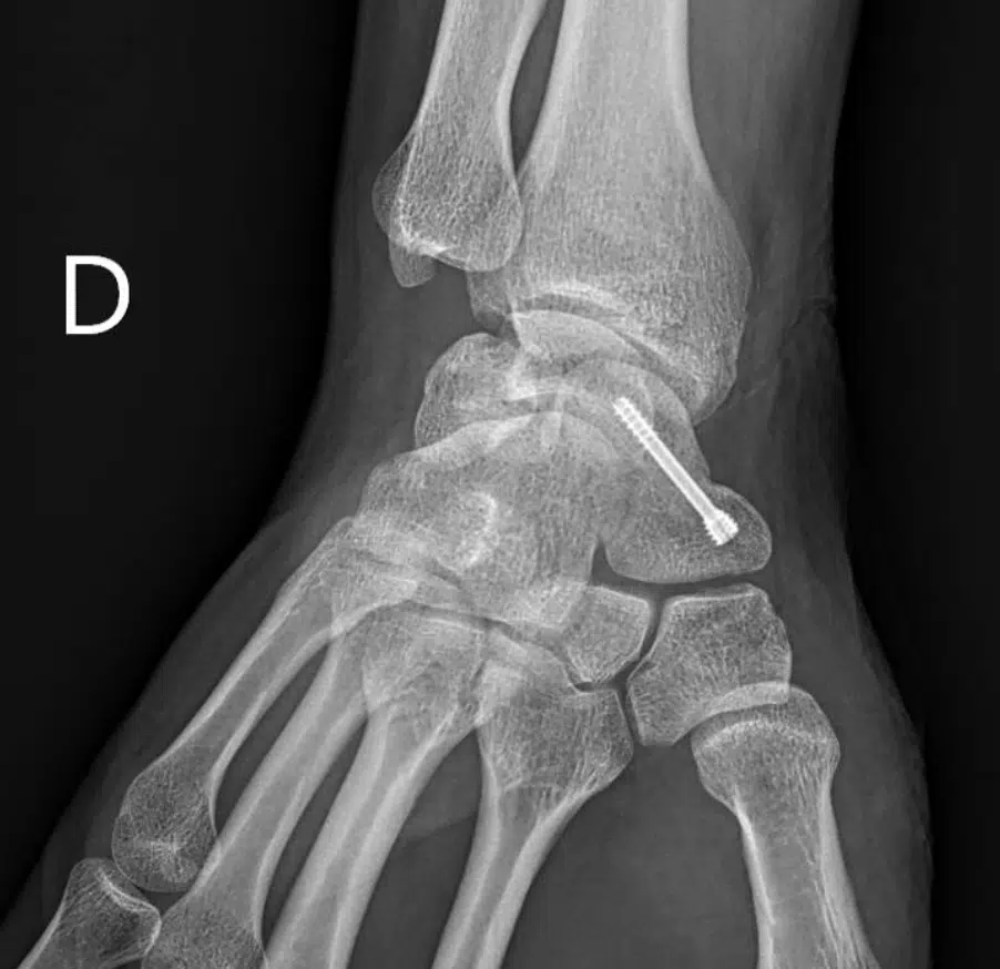Vissage scaphoide