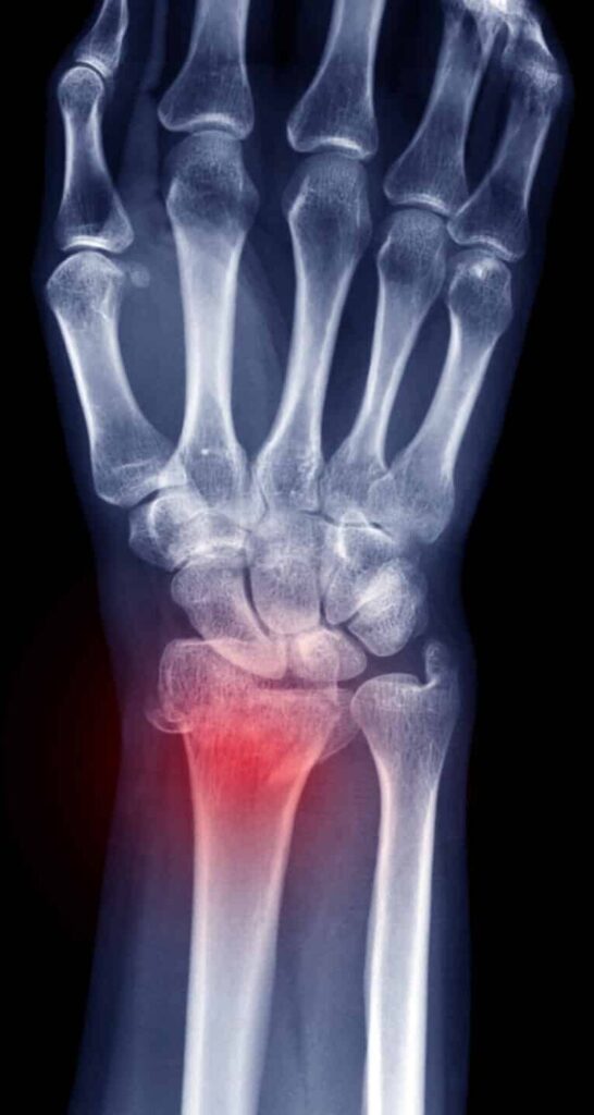 Radiographie de poignet de face, la fracture signalée en rouge sur l'extrémité distale du radius