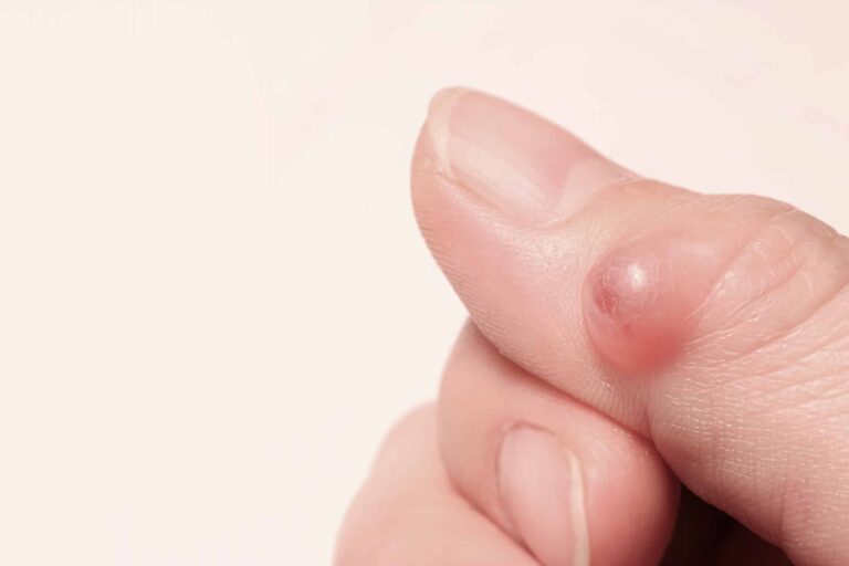 Kyste mucoïde sur la dernière phalange d’un doigt : petite boule translucide bombée à côté de l’ongle