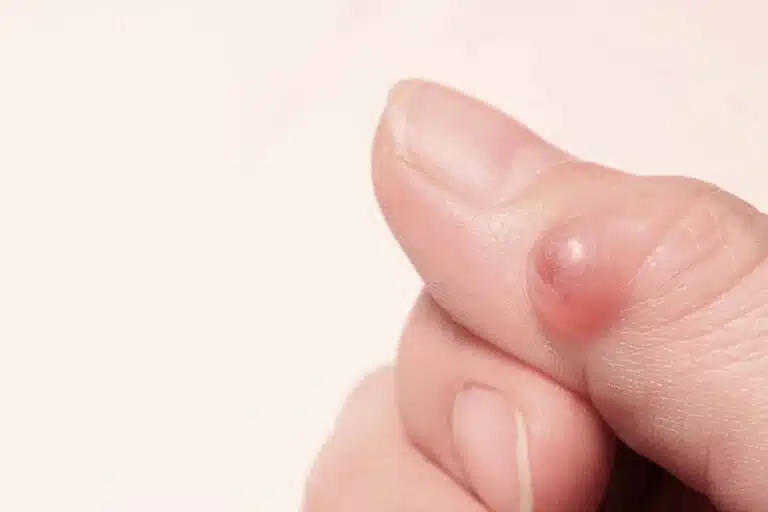 Kyste mucoïde sur la dernière phalange d’un doigt : petite boule translucide bombée à côté de l’ongle