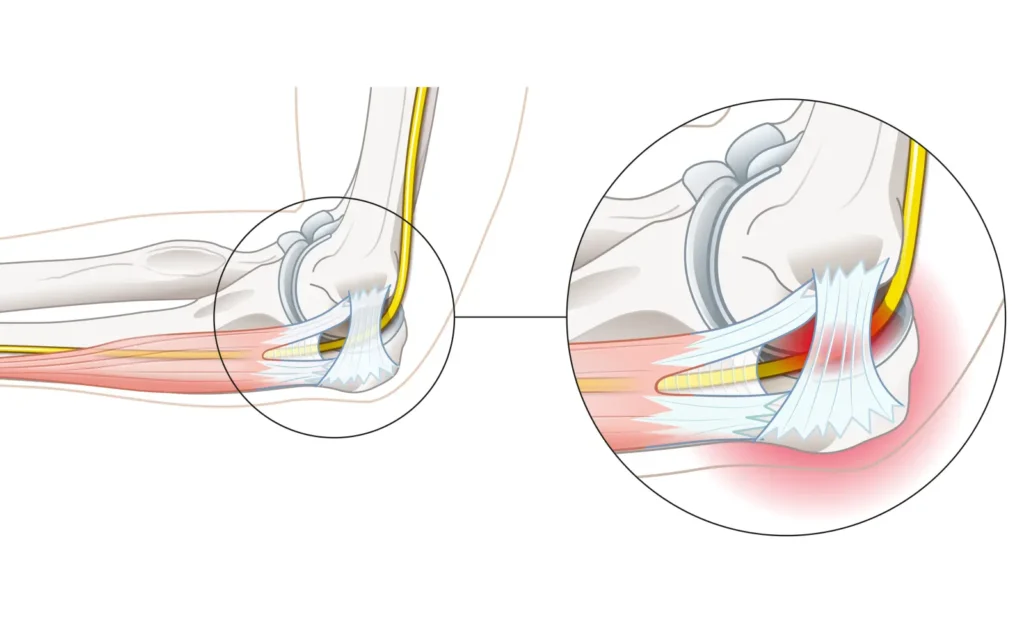 Illustration anatomique du coude, vue rapprochée d'une attache tendineuse sur l'os entourée d'une zone rouge, nerf en jaune
